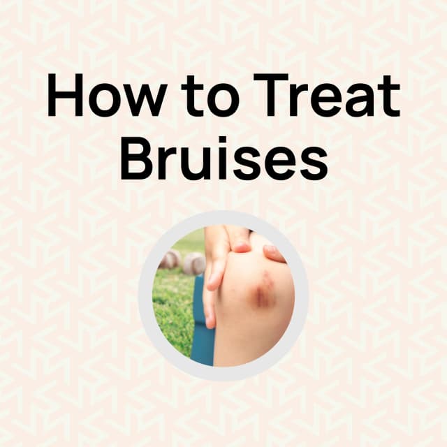 How to Treat Bruises
