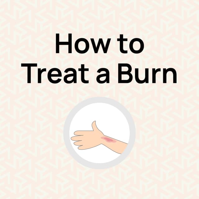 How to Treat a Burn