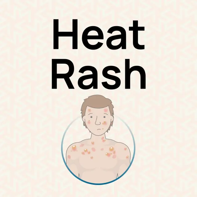 complete-guide-to-heat-rash-relief-uk-guide-hurak